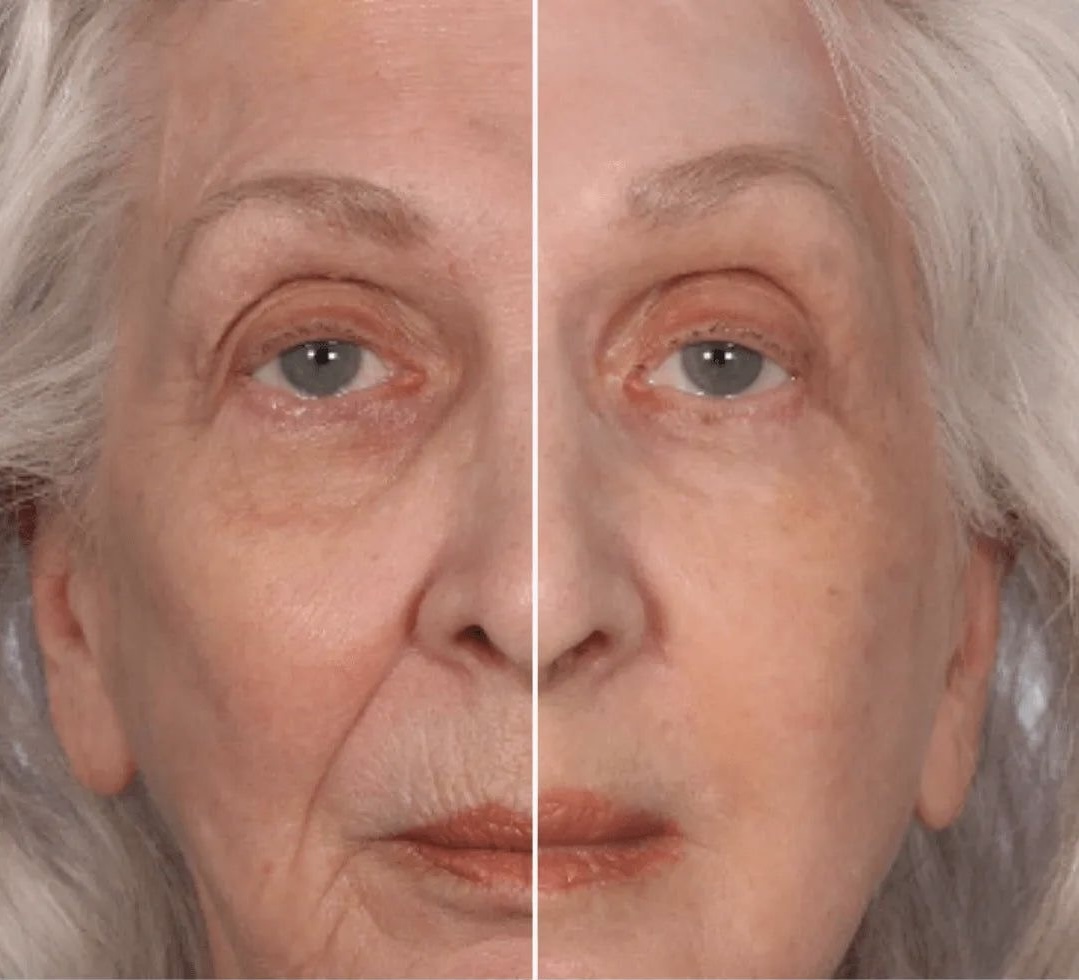 Antes y después yoga facial 1