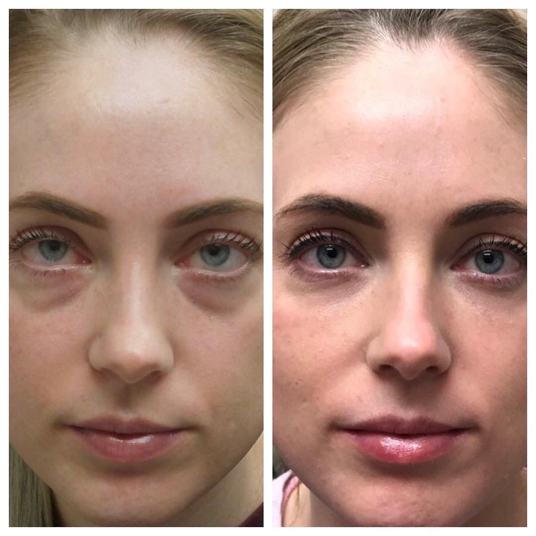 Antes y después yoga facial 2
