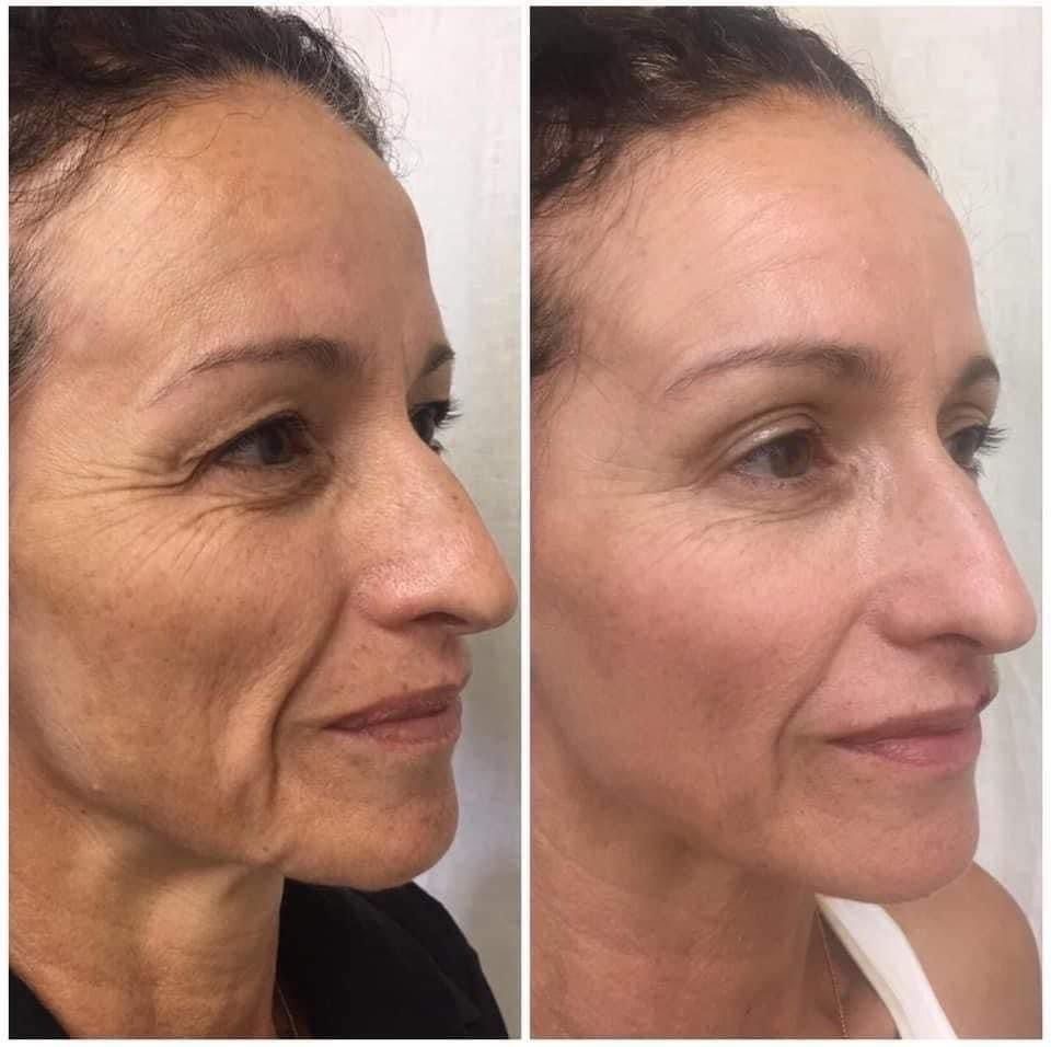 Antes y después yoga facial 3
