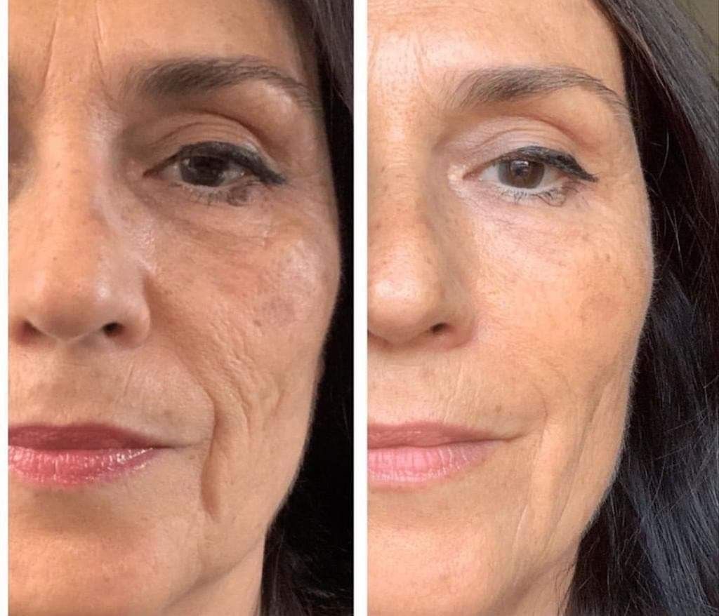 Antes y después yoga facial 4