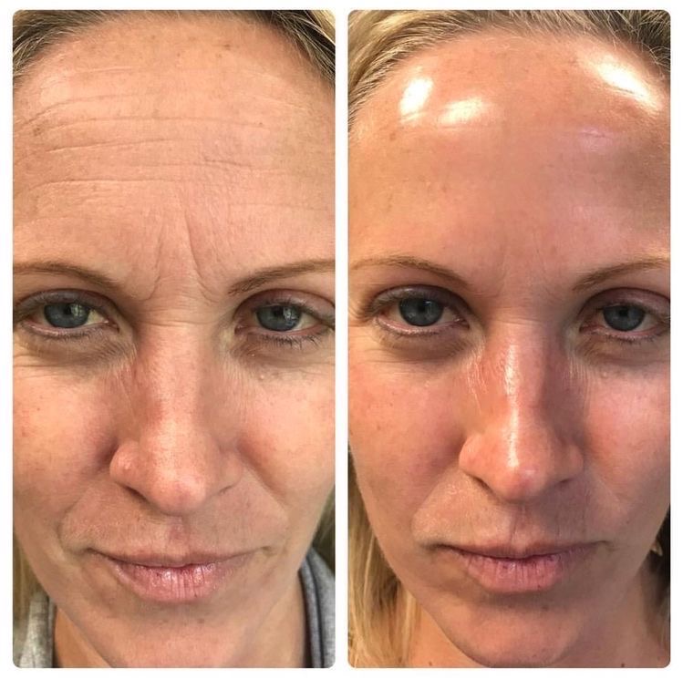 Antes y después yoga facial 5