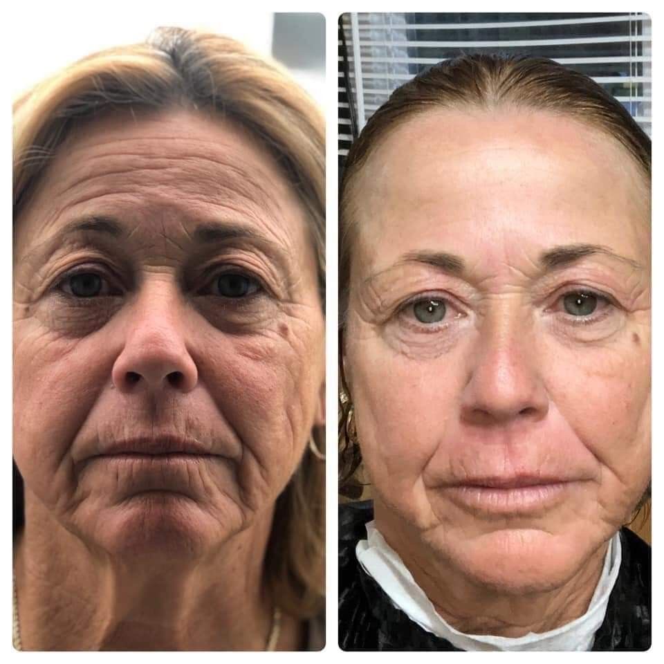 Antes y después yoga facial 7